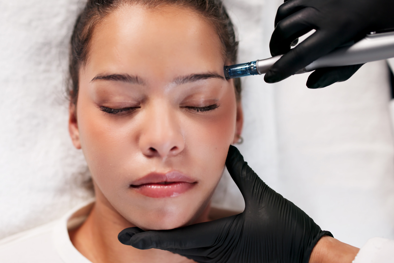PRP i Microneedling Poliklinika Poropat